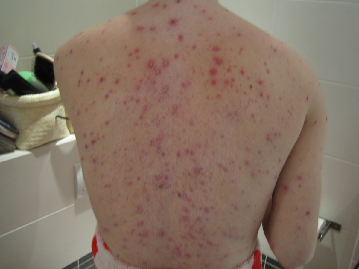 Chickenpox Vaccination in the Netherlands