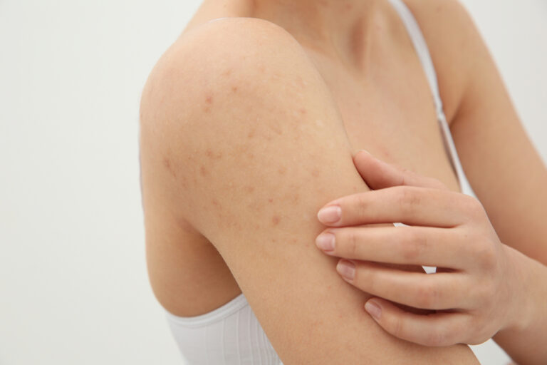 Scabies in the Netherlands: it’s a growing problem