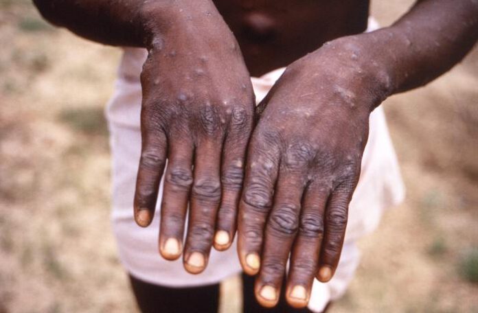 close-up-of-hands-with-monkey-pox-blisters